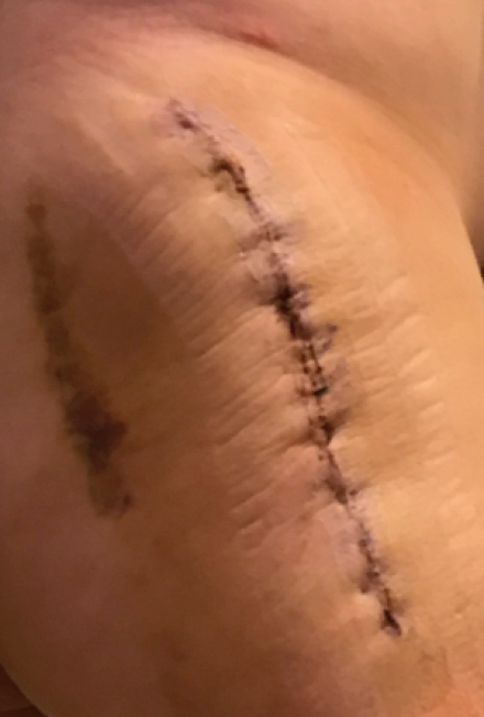 10 days post-op. Immediately after dressing removal. Incision looks good